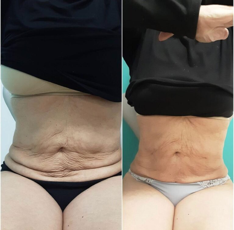 Ultraformer - Antes e Depois