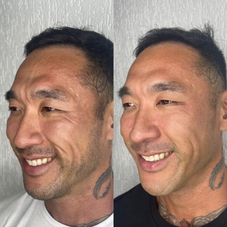 Ultraformer - Antes e Depois