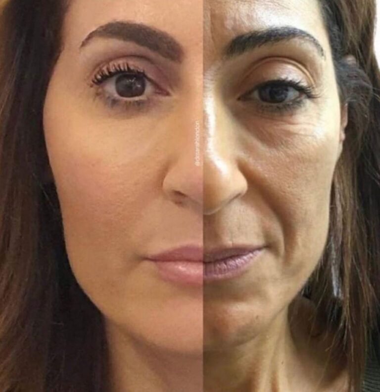 Ultraformer - Antes e Depois