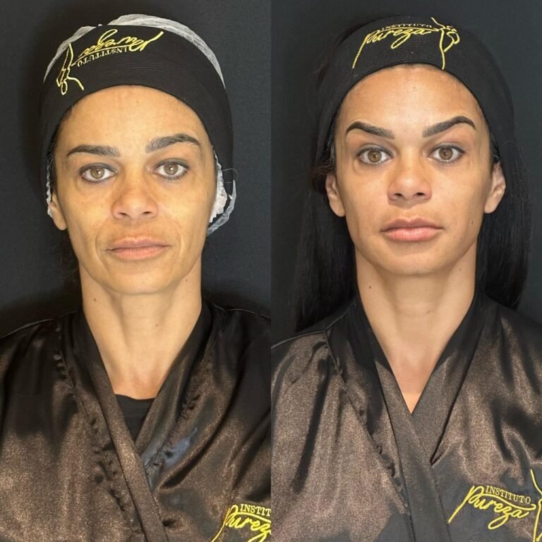 UltrUltraformer - Antes e Depoisaformer