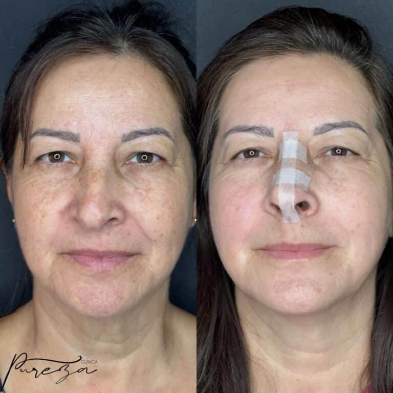 Ultraformer - Antes e Depois