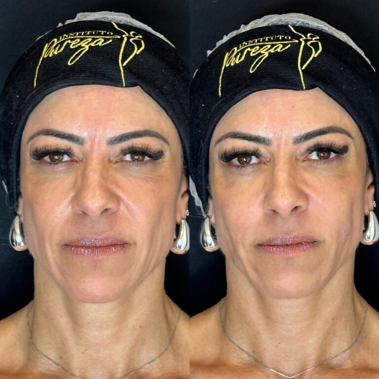 Ultraformer - Antes e Depois