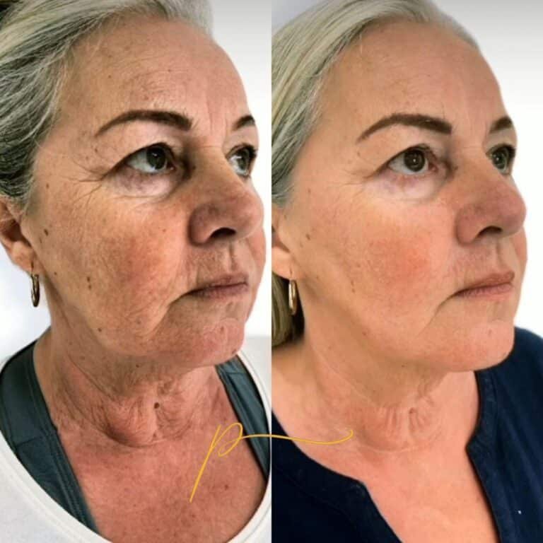 Ultraformer - Antes e Depois