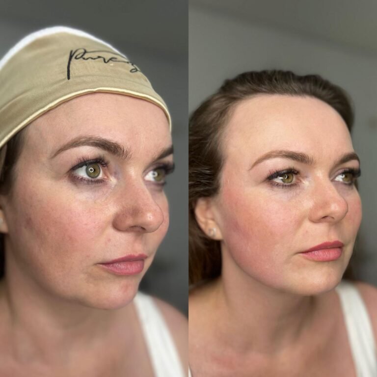 Ultraformer - Antes e Depois