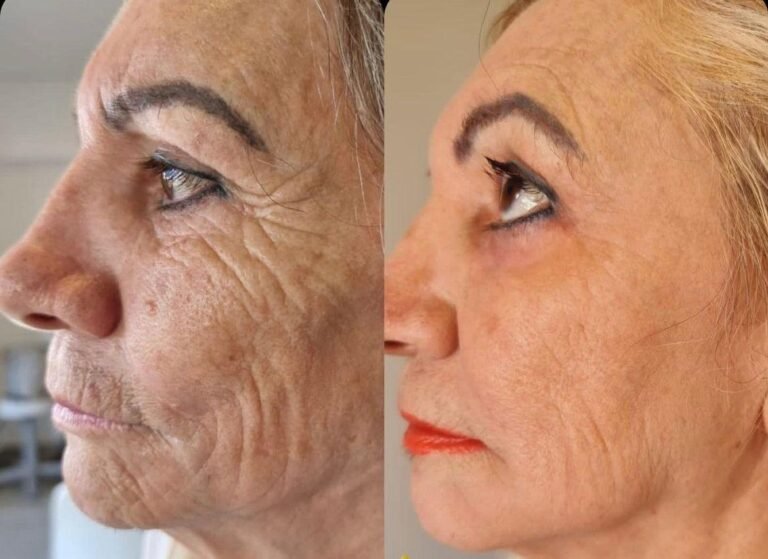 Ultraformer - Antes e Depois